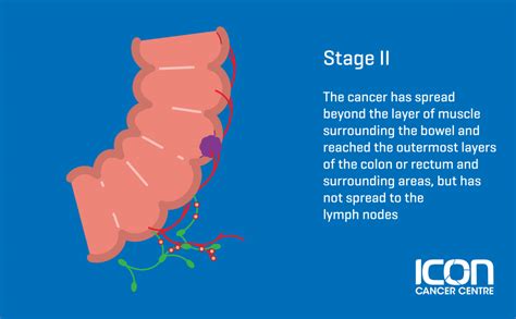 What Is Bowel Cancer Bowel Cancer Explained — Icon Cancer Centre