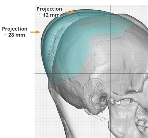 Large Custom Occipital Skull Implant Dimensions Side View Dr Barry