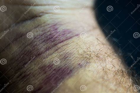 Bruise On Man Arm Injection Bruises High Contrast Macro Photography Purple Veins On The Wrist