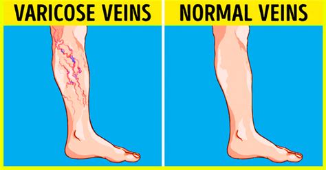 8 Ways To Get Rid Of Varicose Veins At Home Home