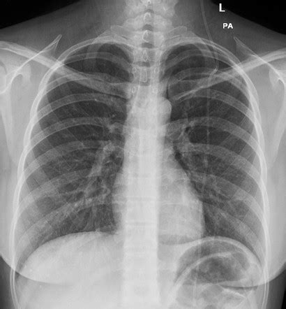 VP Shunt On Chest X Ray Radiology Case Radiopaedia Org