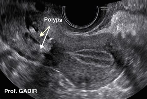 Uterine Polyp As Related To Cervical Polyps Pictures