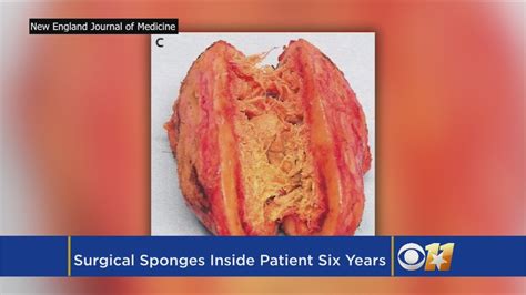 Doctors Find Surgical Sponges Left In Woman For At Least 6 Years YouTube