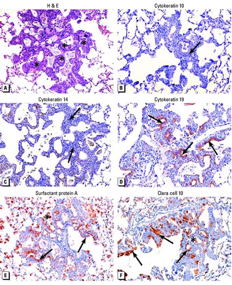 Immunohistochemical Characterization Of Atypical Hyperplastic Lesions