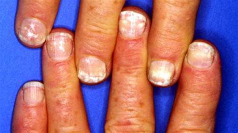 White Spots On The Nails Causes And More