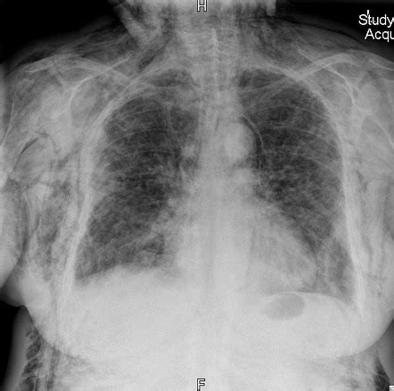 Thoracic Trauma Pneumomediastinum Subcutaneous Emphysema And Rib