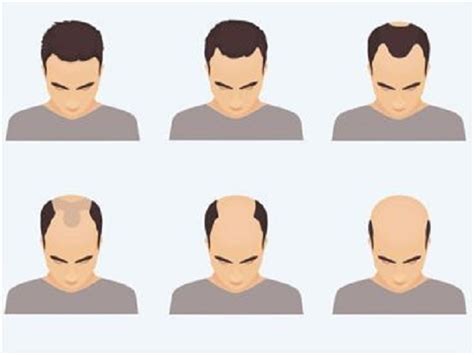 怎么分辨自己的脱发类型 发友网