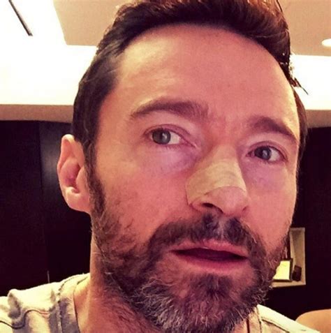 Hugh Jackman Shows Photo Of His Latest Skin Cancer Treatment