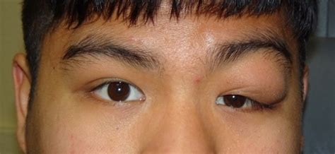 Kimuras Disease Eyewiki