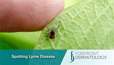 Lyme Disease And Your Skin Forefront Dermatology