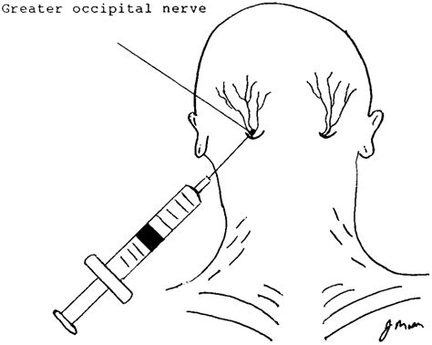 Anatomy And Technique Of Occipital Nerve Block For Treatment Of
