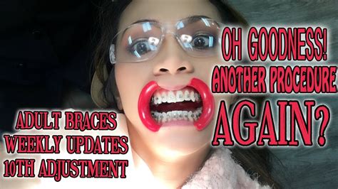 Life Vlog Adult Braces Weekly Updates My 10th Adjustment Arrem Youtube