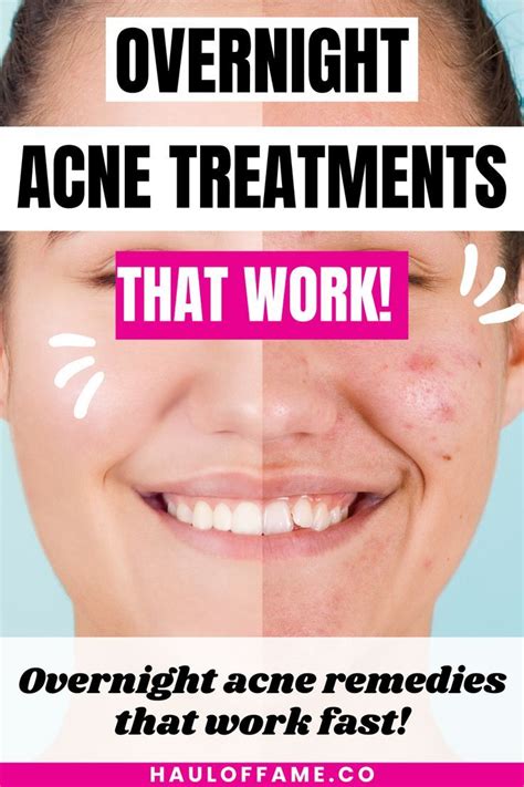 Top 5 Best Overnight Acne Spot Treatments Artofit