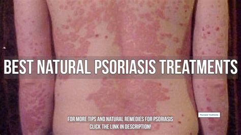 Best Natural Psoriasis Treatments Youtube