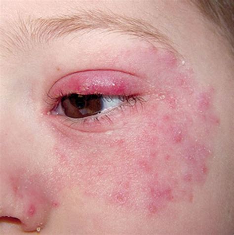 Periocular Rash Clinical Challenge What Would You Do Next Eczema
