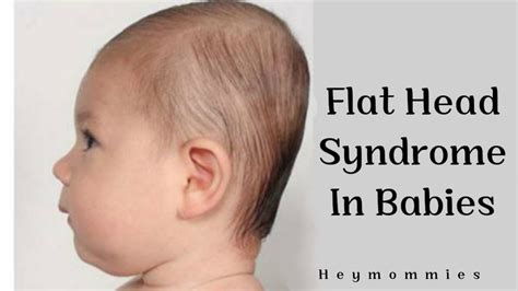 Flat Head Syndrome In Babies Hey Mommies