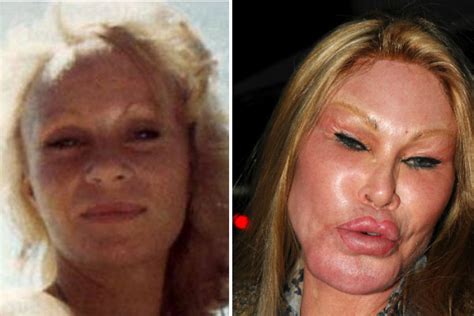 Bad Plastic Surgery Before And After