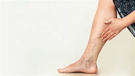 How We Can Help Clear Away Your Spider Veins Jennifer Tauber Dpm
