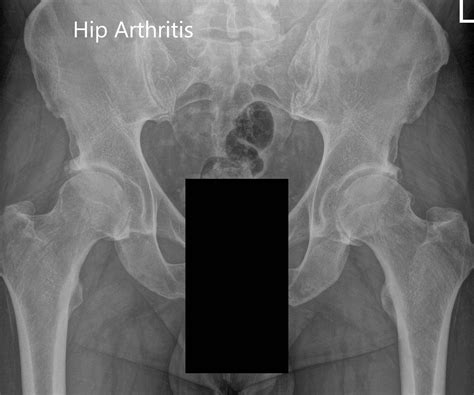 Osteoarthritis X Ray Hip