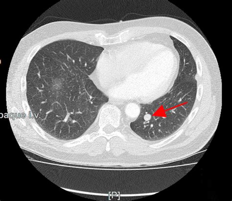 Pulmonary (lung) hamartomas are the most common type of benign lung tumor. Schwerpunkte - Thoraxchirurgie | Ev. Klinikum Bethel - Ihr ...