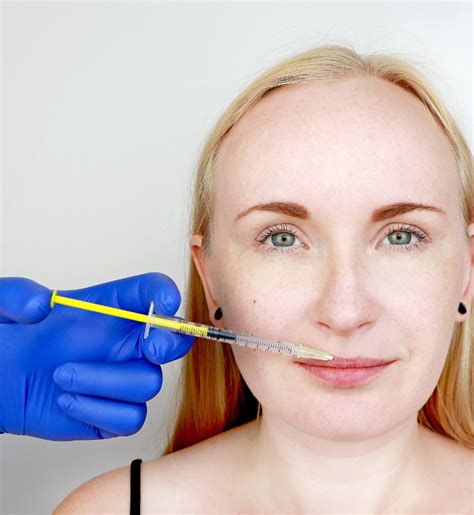 Why And How Fillers Are Best For Fuller Lips