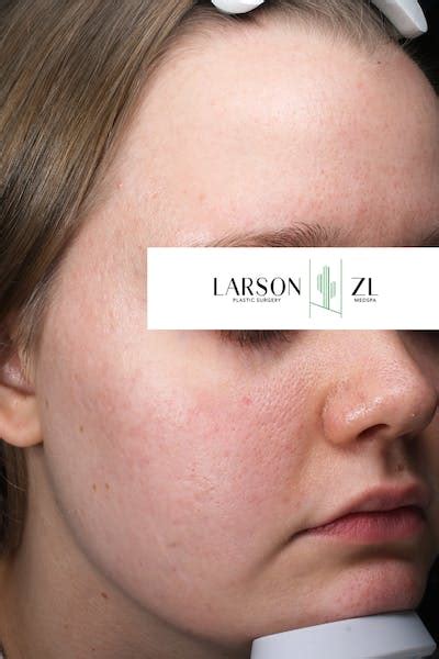 Acne And Acne Scarring Before And After Photos Zl Medspa