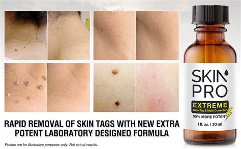 Skinpro Extreme Skin Tag Remover And Mole Corrector Fast