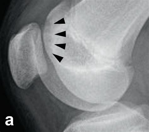 A Lateral View Radiograph Of The Right Knee Showing Brückls Stage Ii