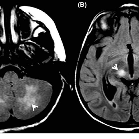 A Cerebellar Lesions With Moderate Cerebral Edema B High Intensity