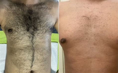 Before And After Photos Hrh Laser Hair Treatments