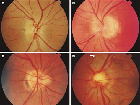 Acute Idiopathic Blind Spot Enlargement Syndrome A Review Of 27 New