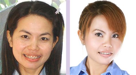 dr chettawut sex reassignment and facial feminization surgery center upper eyelid double