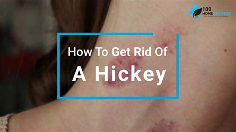 How To Get Rid Of A Hickey Fast Learn How To Cover A Hickey With