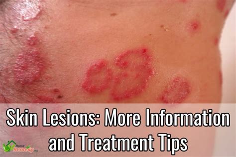 Skin Lesions More Information And Treatment Tips Home