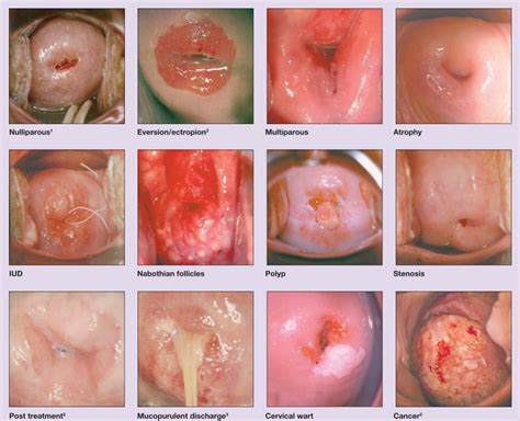 But if you experience persistent bloating. Cervical cancer or polyp Simptome de paraziti la copii