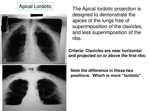 Ppt Rdsc 233 Unit 1 Radiography Of The Chest Bontrager Chapter 3