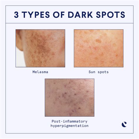 The Different Types Of Hyperpigmentation And How To Treat Them