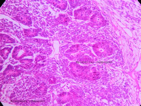 Wilms Tumor Ug Slide Histopathologyguru