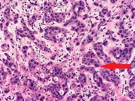 Cureus Paraneoplastic Leukocytosis A Poor Prognostic Marker In