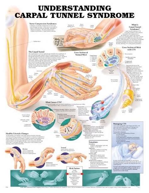 Carpal Tunnel Syndrome Poster Carpal Tunnel Anatomical Chart Co