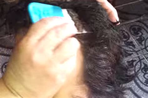 Head Lice Video Shows Worst Case Of Nits You Will Ever See Huffpost Uk