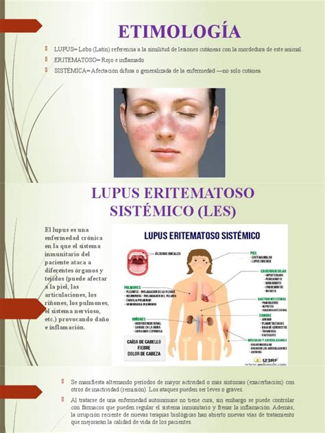 Lupus Eritematoso Sistémico Pdf Especialidades Medicas Medicina