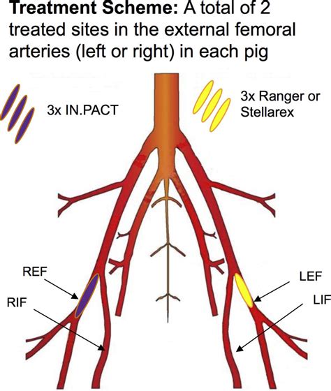 Illustration Of The Treatment Strategy In Femoral Arteries Of Healthy