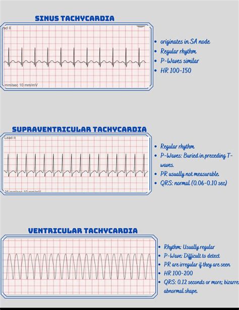 Tachycardia EKG Rhythm Strips Etsy