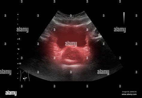Ultrasound Of Urinary Bladder Or Kub For Screening Renal And Bladder
