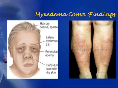 Pretibial Myxedema Pathophysiology
