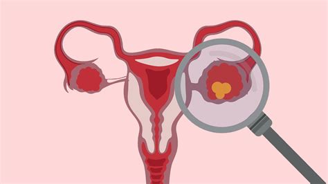 Ovarian Cysts Signs Symptoms And Medical Advice Glamour Uk