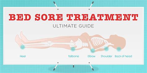 Bed Sores Treatment Ultimate Guide Vive Health