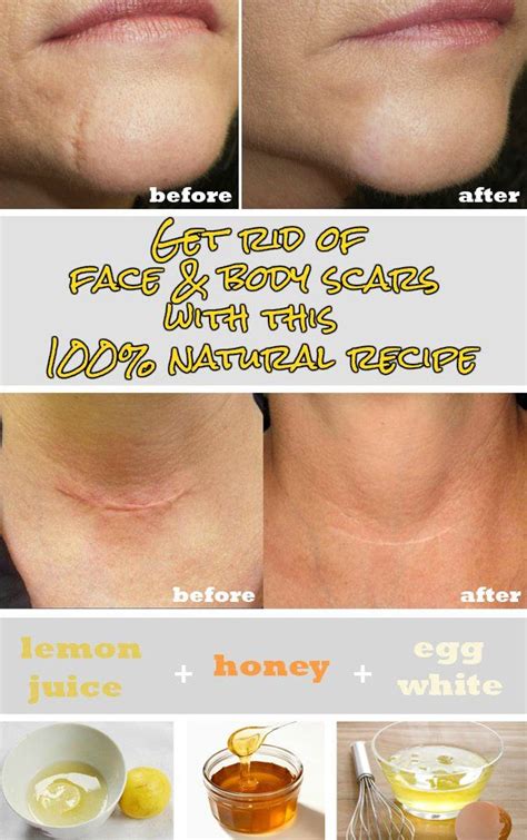 Diy Skin Care Recipes Get Rid Of Face And Body Scars With This 100