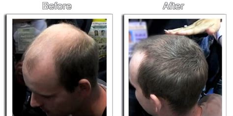 If you are uncertain about any of the information, consult your. Caboki Hair Loss Product For Bald Men - Business Insider